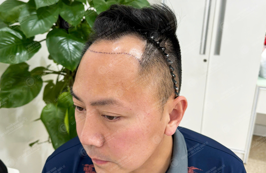 Phùng Minh Sơn - Cấy tóc đường chữ M 3