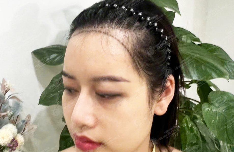 Nguyễn Quỳnh Ly - Cấy tóc đường chữ M 3