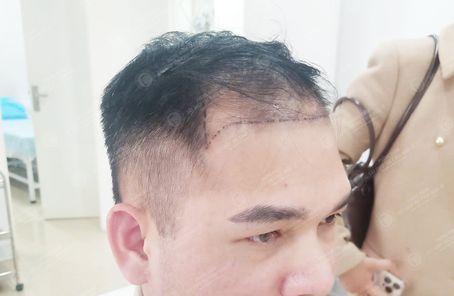 Trần Thanh Hưng - Cấy tóc đường chữ M 3