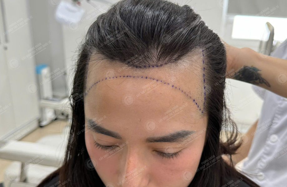 Đinh Thị Hà - Cấy tóc đường chữ M 3