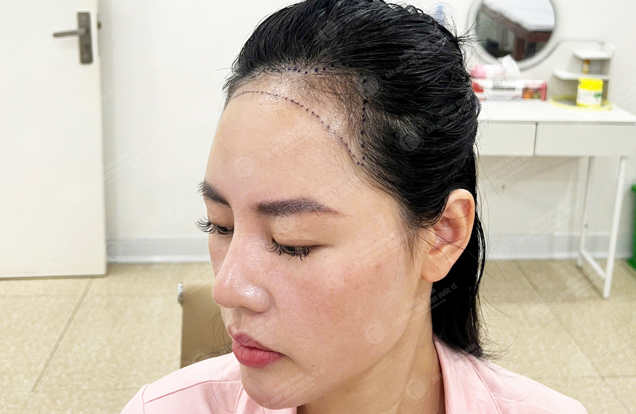Ngô Thùy Linh - Cấy tóc đường chữ M 3