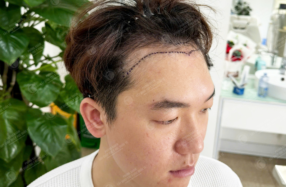 Chih Cheng - Cấy tóc đường chữ M 3