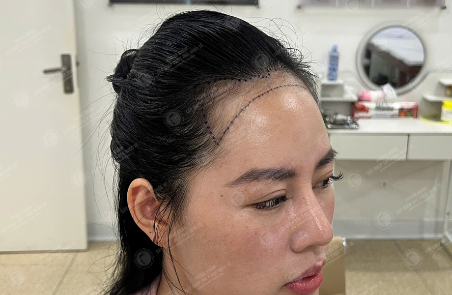 Lê Lan Anh - Cấy tóc đường chữ M 3