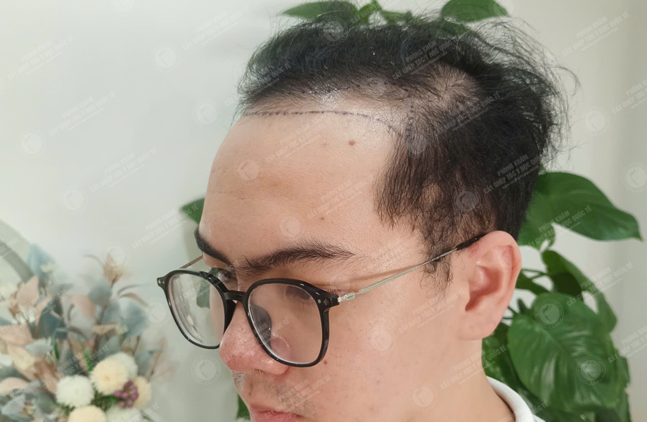 Trần Văn Đông - Cấy tóc đường chữ M 3