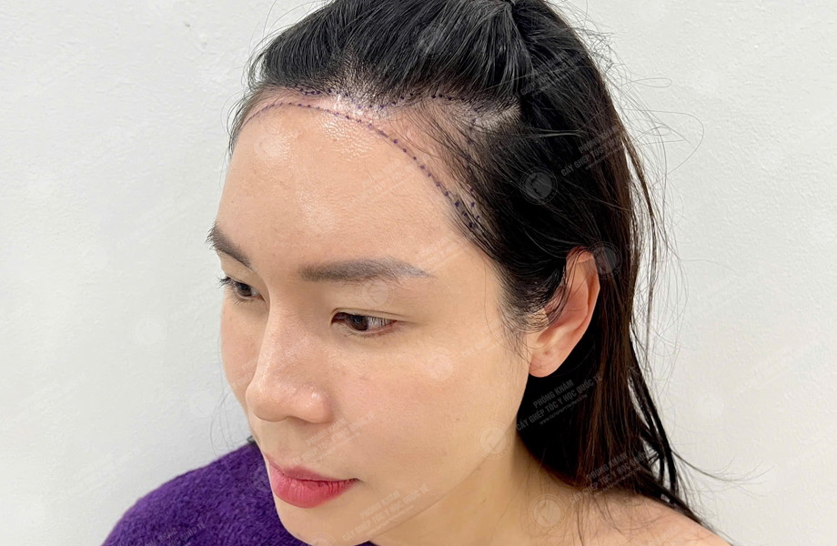 Nguyễn Thị Hồng - Cấy tóc đường chữ M 3