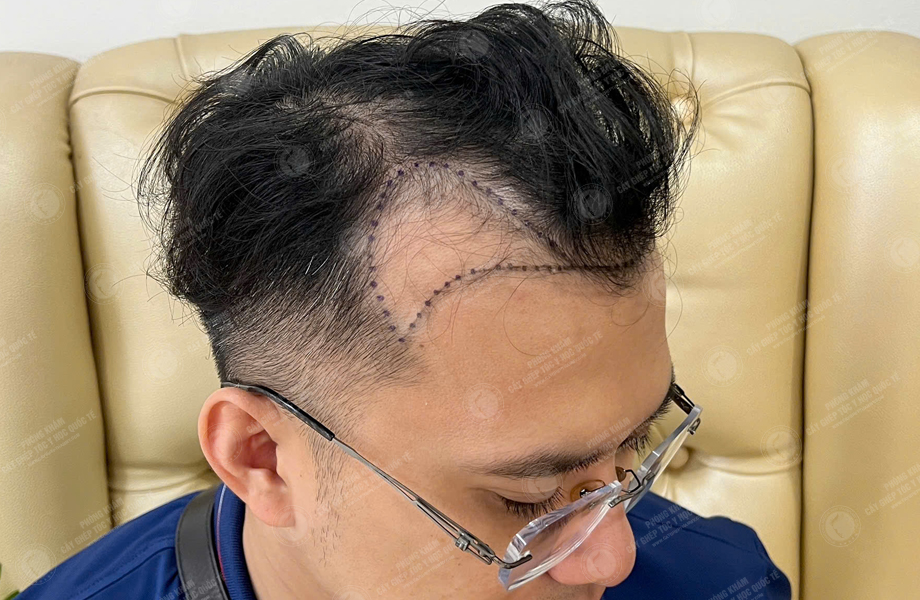 Nguyễn Thành Tiến - Cấy tóc đường chữ M 3