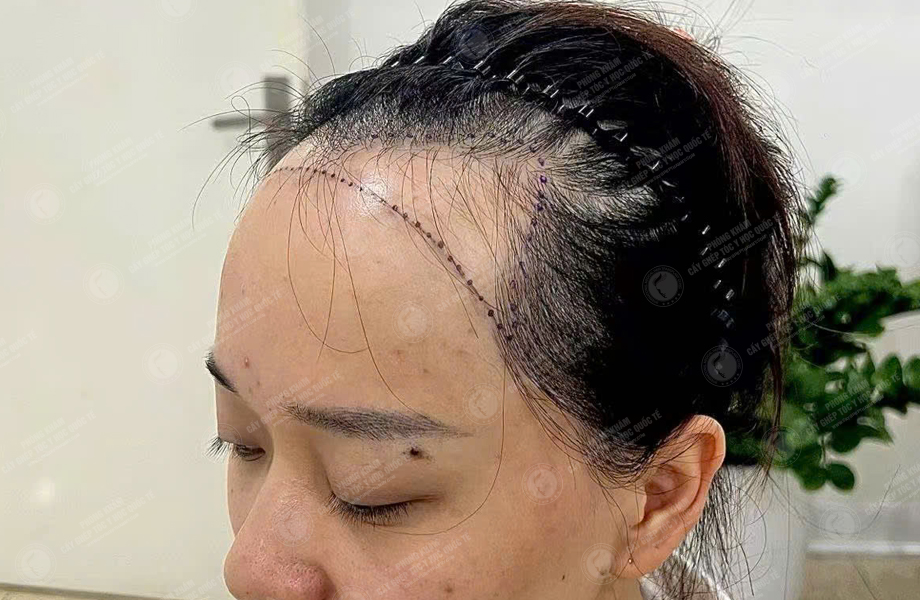 Nguyễn Hồng Ánh - Cấy tóc đường chữ M 3