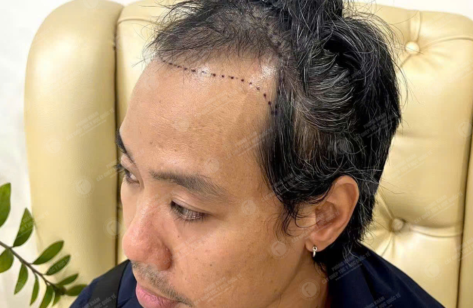 Lý Hùng Mạnh - Cấy tóc đường chữ M 3