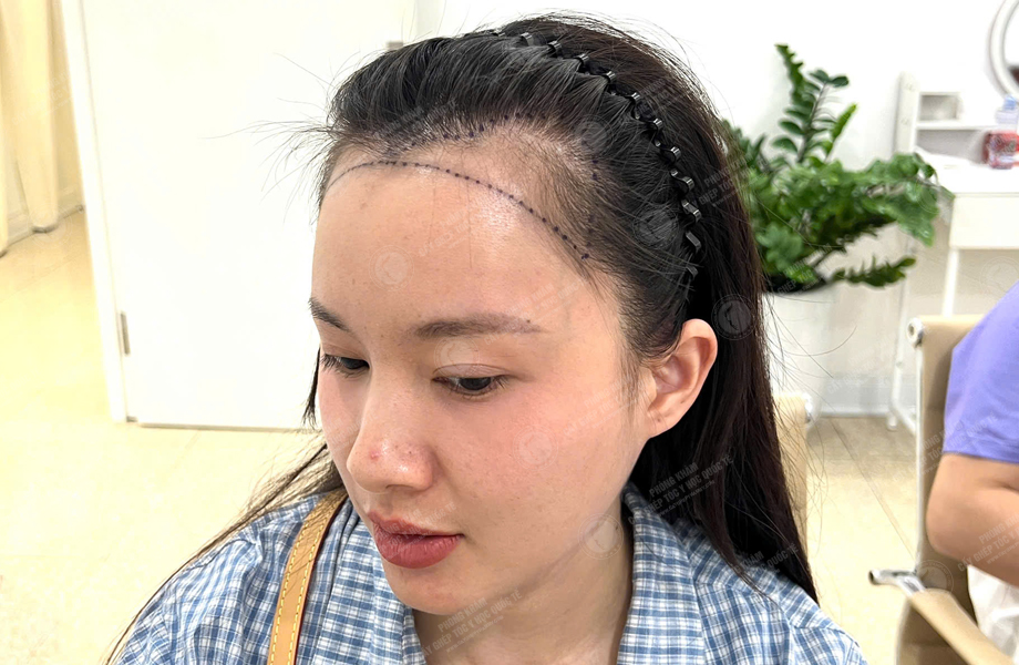 Trần Thị Mận - Cấy tóc đường chữ M 3