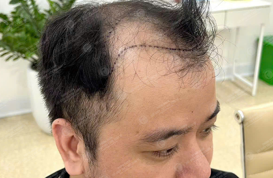 Đỗ Tùng Sơn - Cấy tóc đường chữ M 3