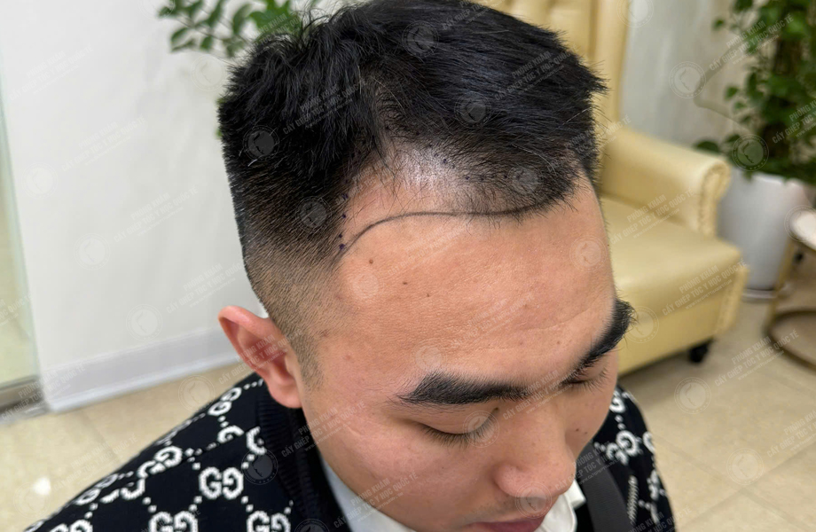 Nguyễn Hoàng Trung - Cấy tóc đường chữ M 3