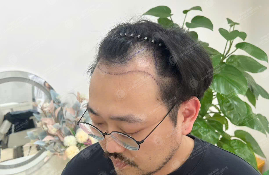 Phạm Tuấn Hùng - Cấy tóc đường chữ M 3