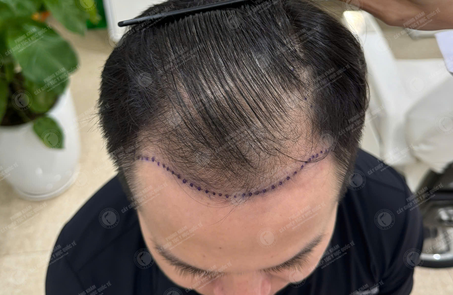 Trần Ngọc Thanh - Cấy tóc đường chữ M 3
