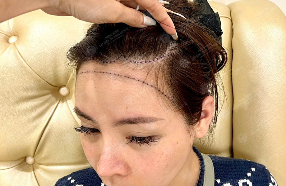 Mai Thị Hoa - Cấy tóc đường chữ M 3