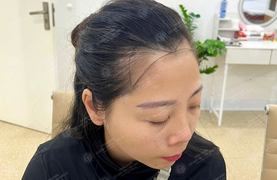 Lê Thị Lý - Cấy tóc đường chữ M 3