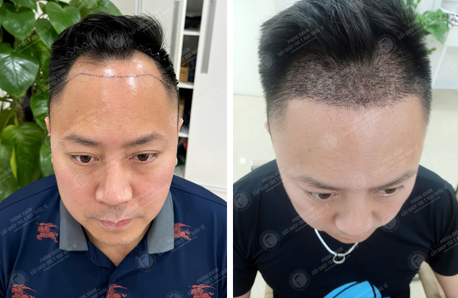  Phùng Minh Sơn - Cấy tóc tự thân 1