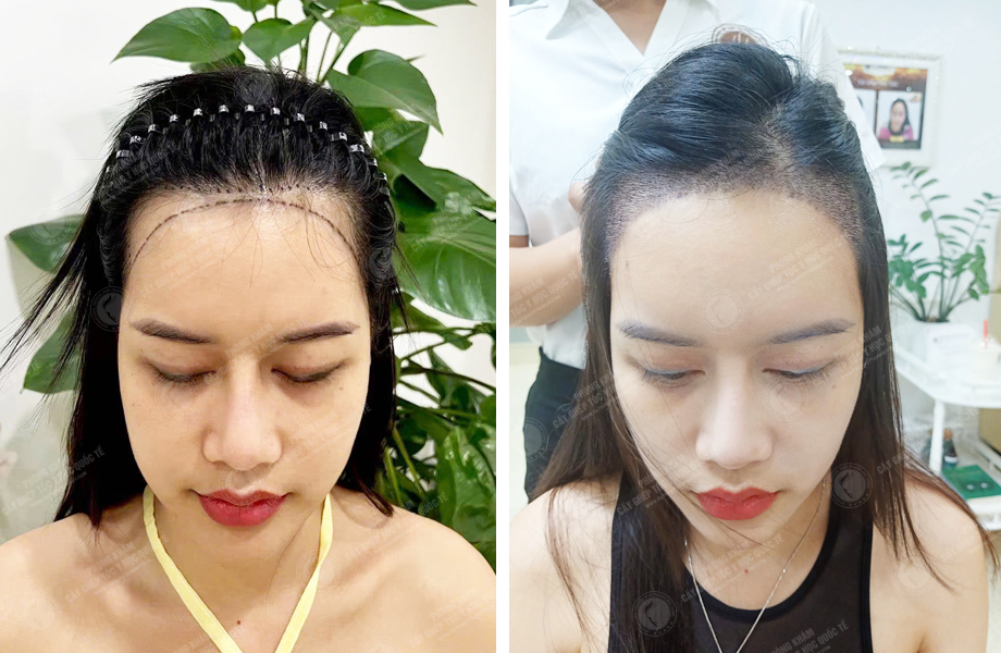  Nguyễn Quỳnh Ly - Cấy tóc đường chữ M 1