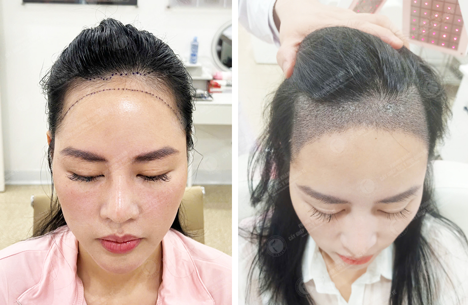  Ngô Thùy Linh - Cấy tóc tự thân 1