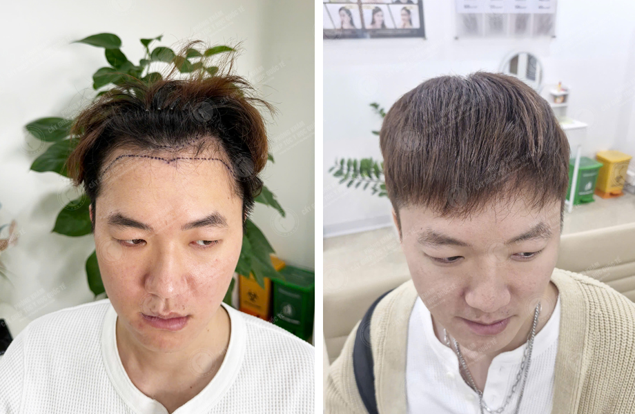  Chih Cheng - Cấy tóc tự thân 1
