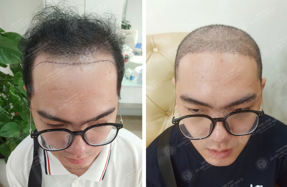  Trần Văn Đông - Cấy tóc tự thân 1