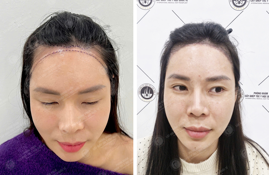  Nguyễn Thị Hồng - Cấy tóc tự thân 1