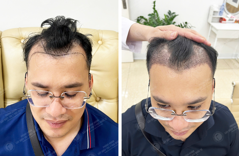  Nguyễn Thành Tiến - Cấy tóc tự thân 1