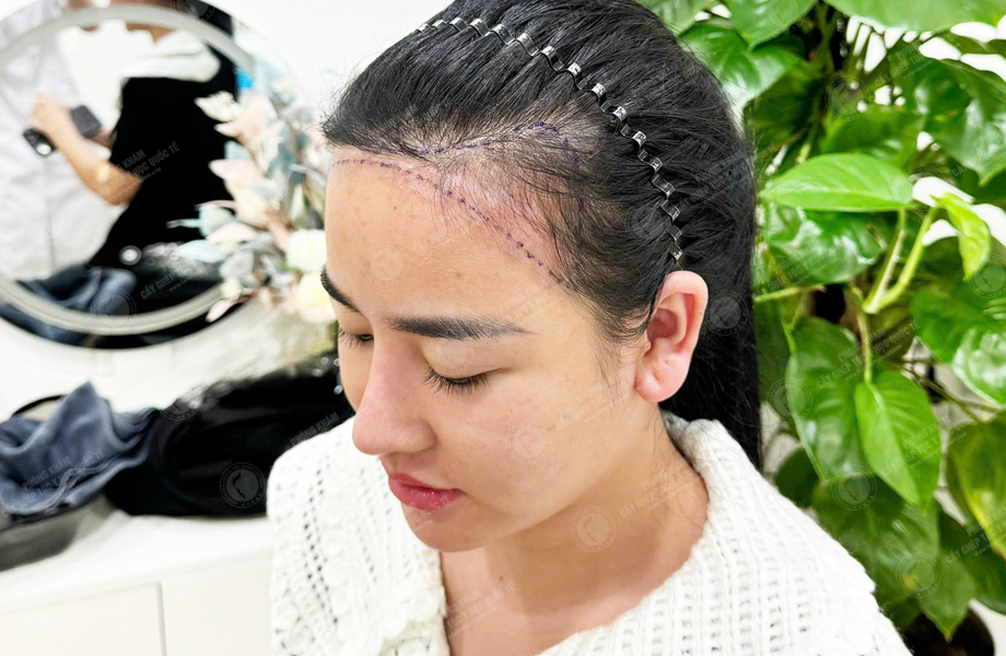 Ngô Thanh Lan - Cấy tóc đường chữ M 4