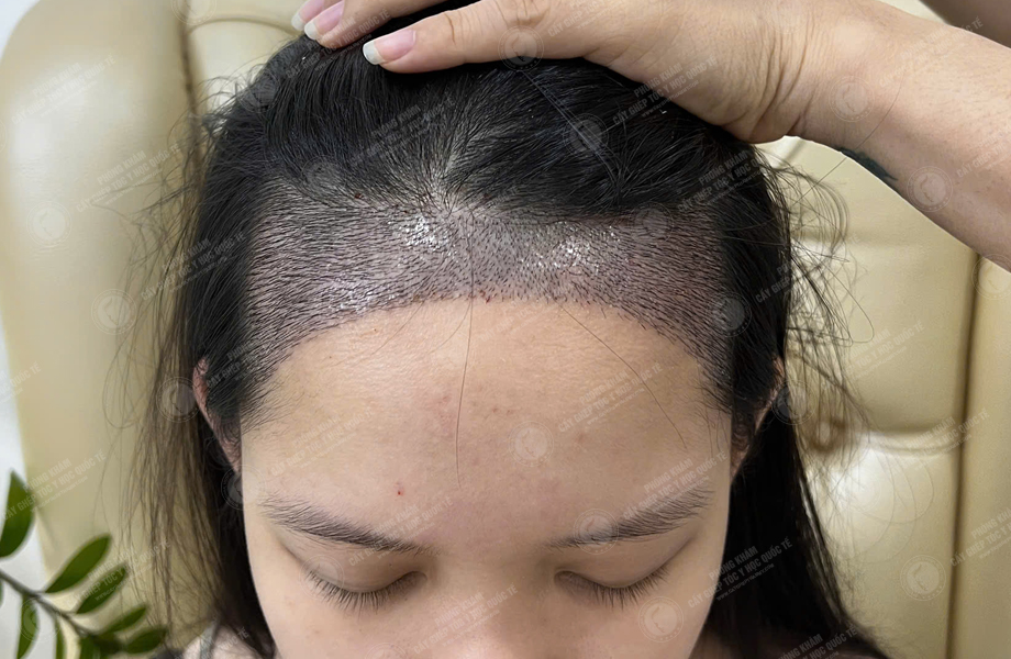 Nguyễn Hồng Ngọc - Cấy tóc đường chữ M 4