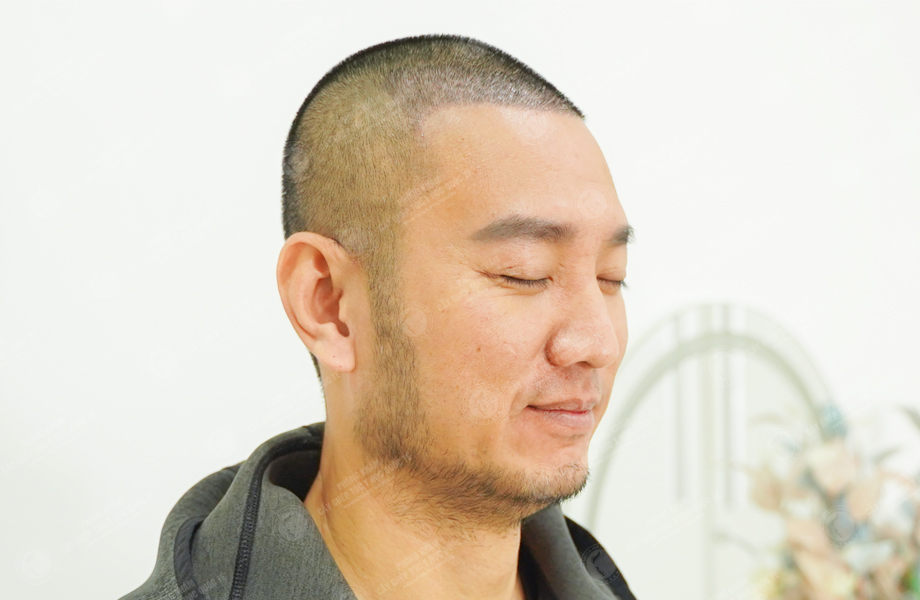 Youtuber Hùng Lâm - Cấy tóc đường chữ M 4