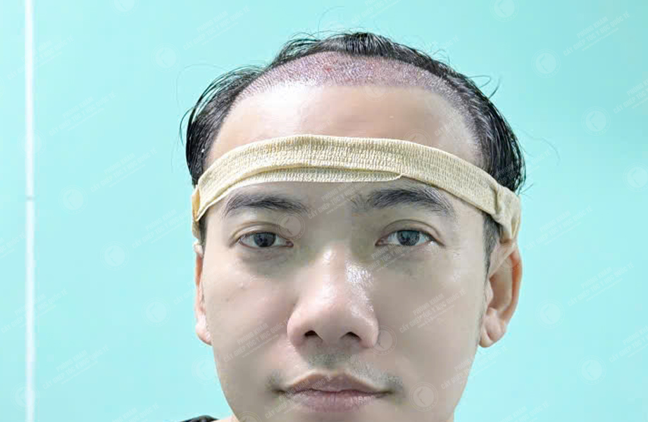 Ca sĩ Phạm Trưởng - Cấy tóc đường chữ M 4