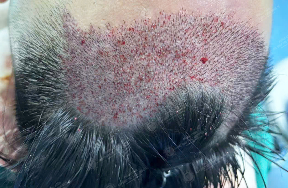 Phùng Minh Sơn - Cấy tóc đường chữ M 4