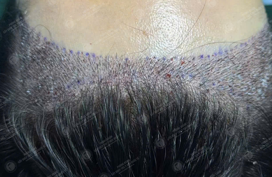 Nguyễn Quỳnh Ly - Cấy tóc đường chữ M 4