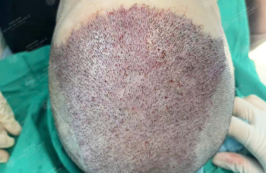 Trần Thanh Hưng - Cấy tóc đường chữ M 4