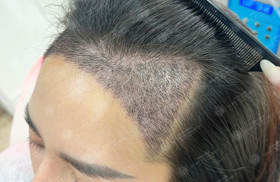 Đinh Thị Hà - Cấy tóc đường chữ M 4