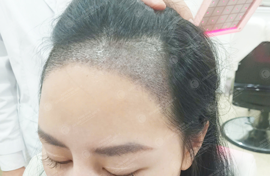 Ngô Thùy Linh - Cấy tóc đường chữ M 4