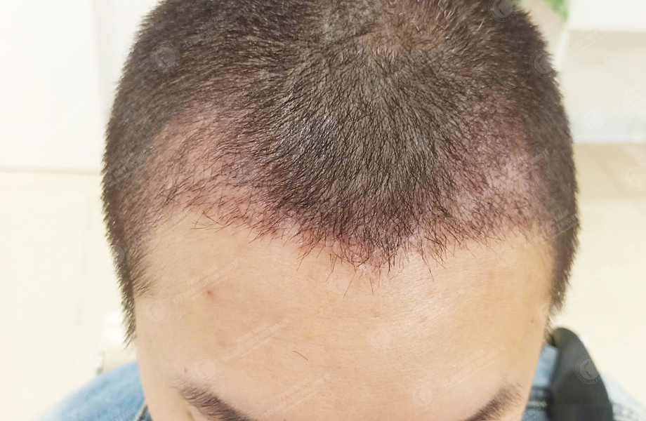 Chih Cheng - Cấy tóc đường chữ M 4