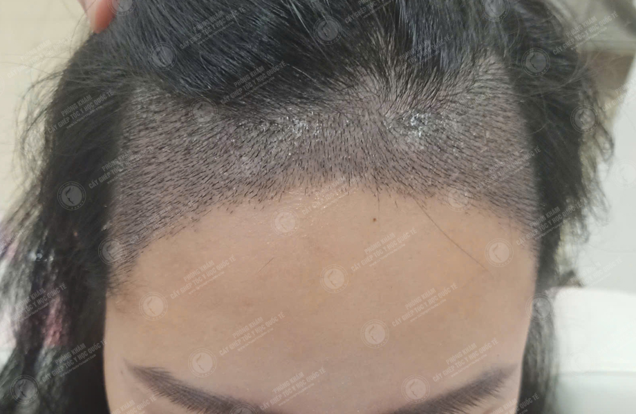 Lê Lan Anh - Cấy tóc đường chữ M 4