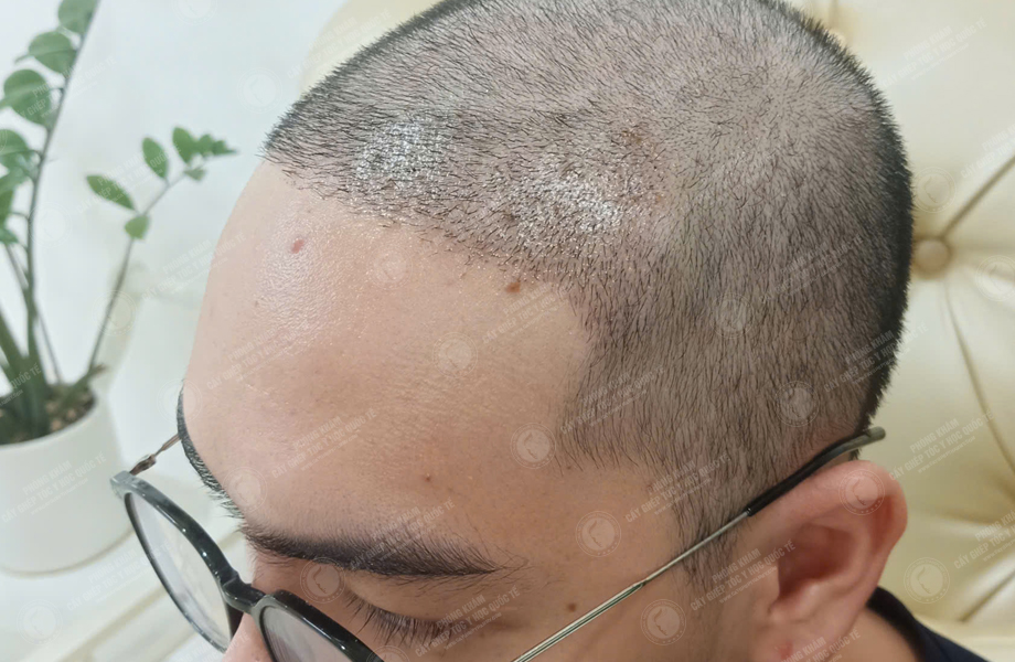 Trần Văn Đông - Cấy tóc đường chữ M 4