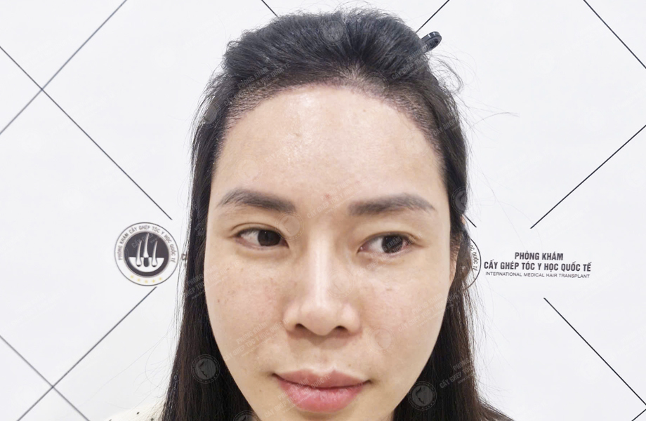 Nguyễn Thị Hồng - Cấy tóc đường chữ M 4