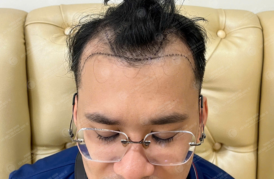 Nguyễn Thành Tiến - Cấy tóc đường chữ M 4
