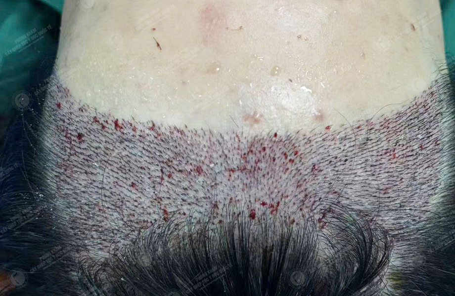 Nguyễn Hồng Ánh - Cấy tóc đường chữ M 4