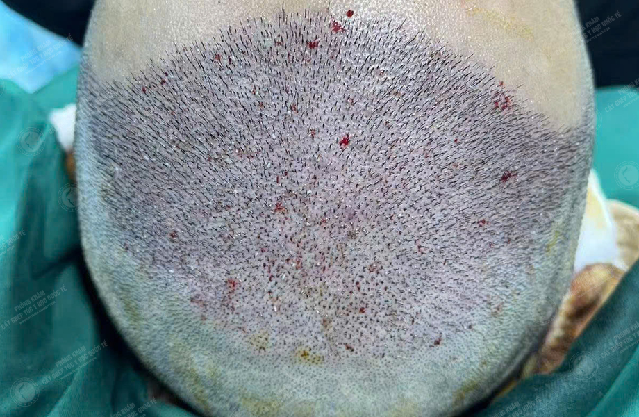 Lý Hùng Mạnh - Cấy tóc đường chữ M 4