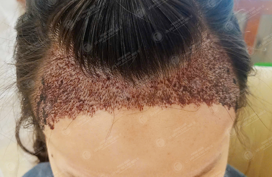 Trần Thị Mận - Cấy tóc đường chữ M 4