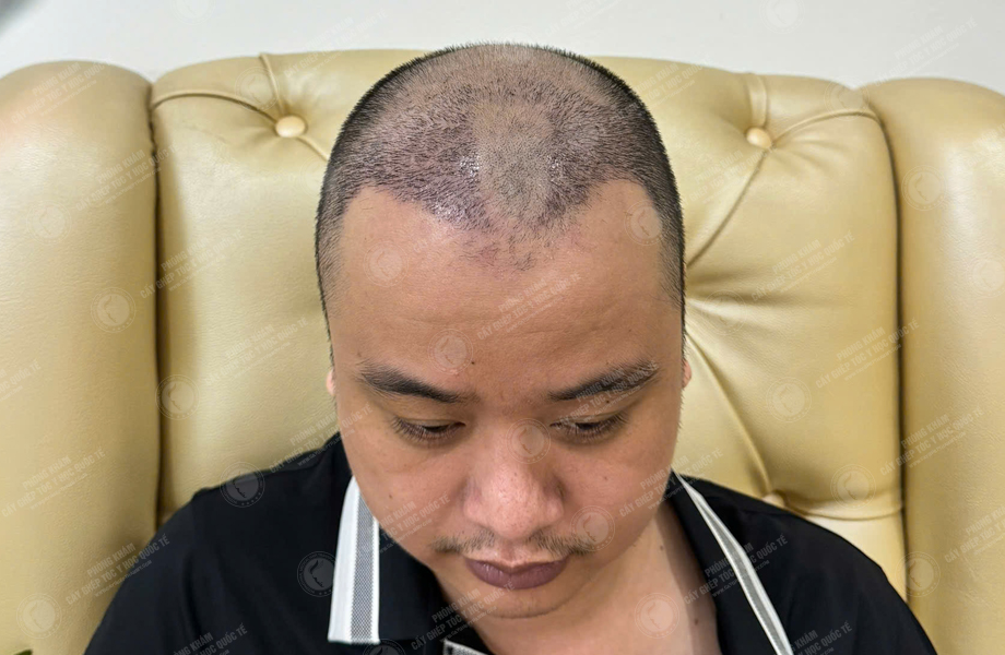 Đỗ Tùng Sơn - Cấy tóc đường chữ M 4