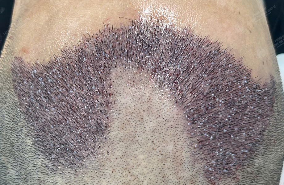 Nguyễn Hoàng Trung - Cấy tóc đường chữ M 4