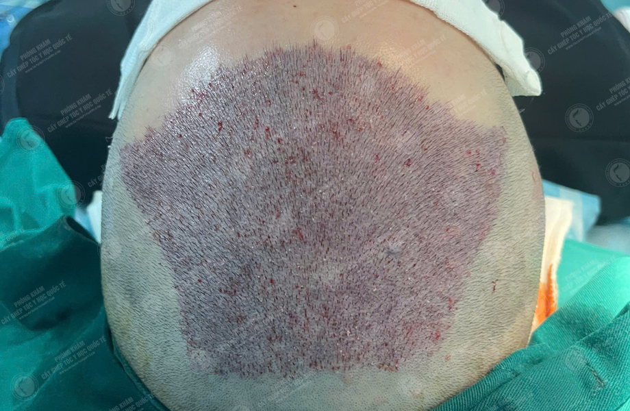 Trần Ngọc Thanh - Cấy tóc đường chữ M 4