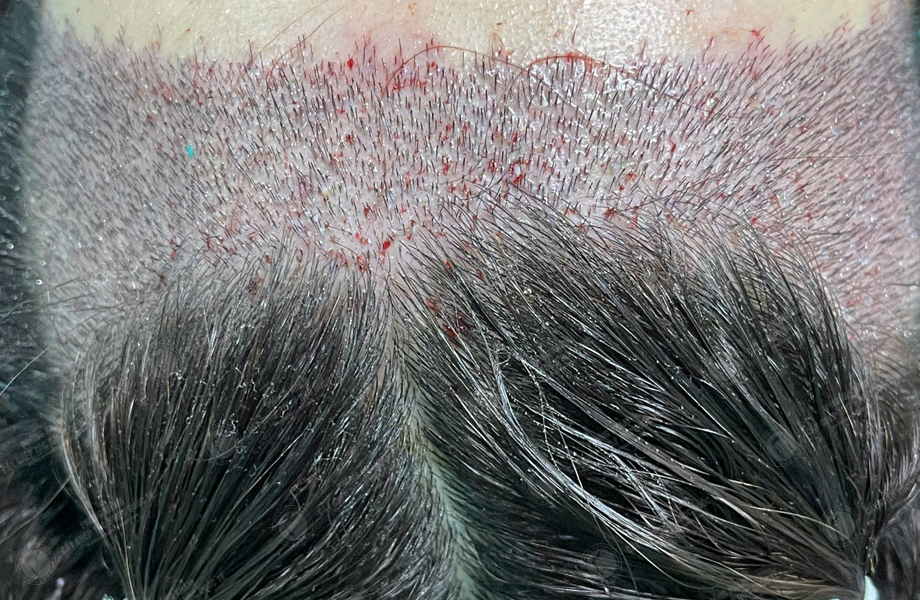 Mai Thị Hoa - Cấy tóc đường chữ M 4