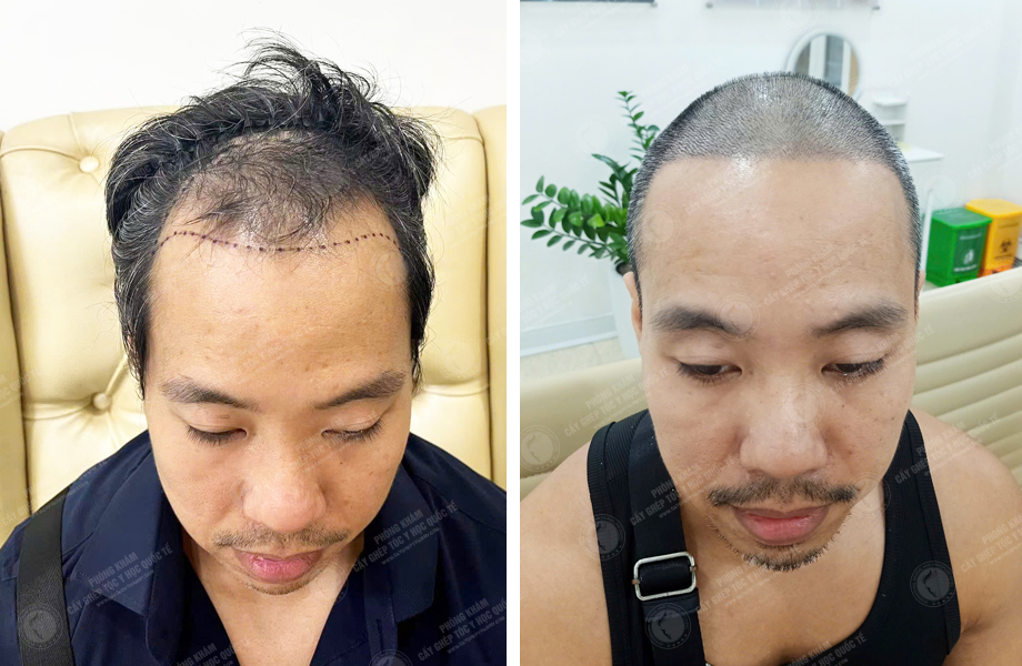  Lý Hùng Mạnh - Cấy tóc đường chữ M 1