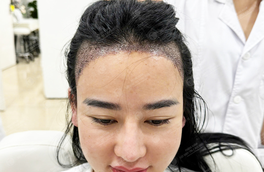Ngô Thanh Lan - Cấy tóc đường chữ M 5