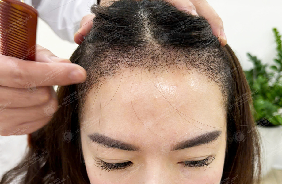 Ngô Thùy Dung - Cấy tóc đường chữ M 5